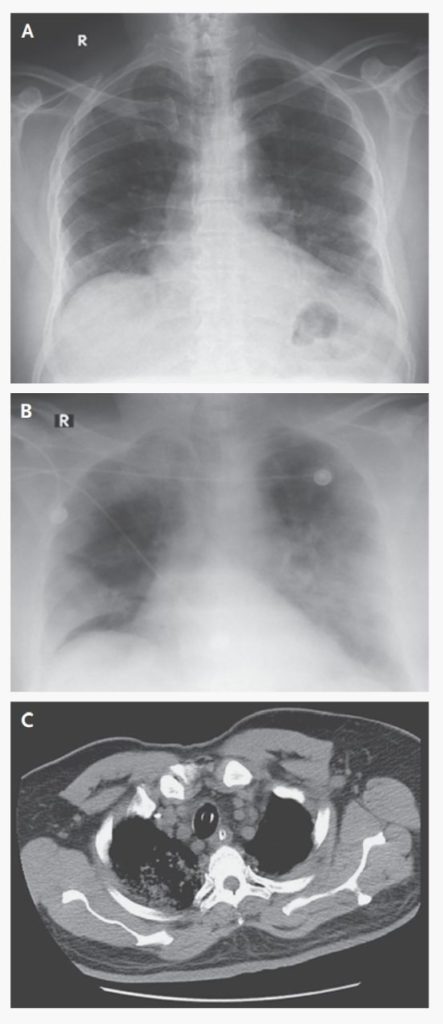 Anormalidades na imagem do tórax do paciente saudita infectado com Coronavírus
