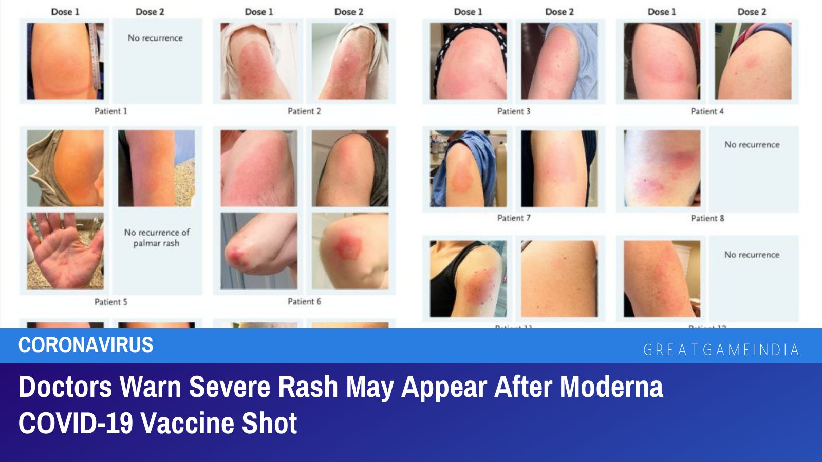 Doctors Warn Severe Rash May Appear After Moderna COVID-19 Vaccine Shot.