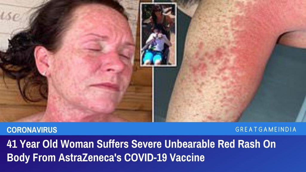 41 Year Old Woman Suffers Severe Unbearable Red Rash On Body From AstraZeneca's COVID-19 Vaccine