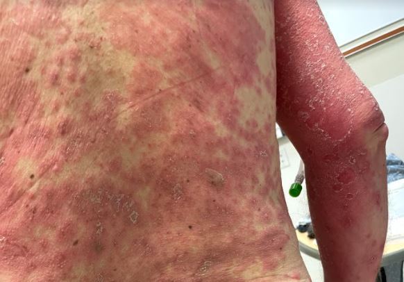 Goochland County Man's Skin Peels Off After Extreme Adverse Reaction To COVID-19 Vaccine
