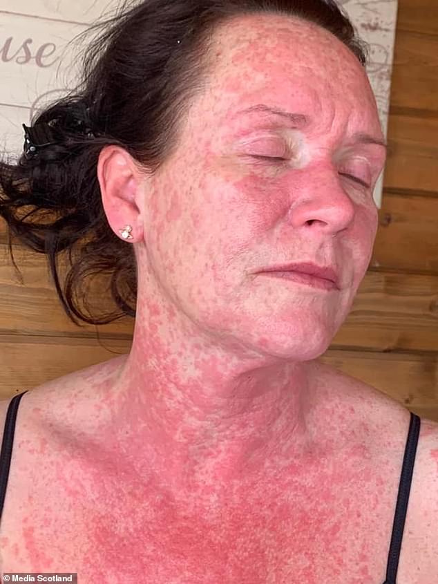 41 Year Old Woman Suffers Unbearable Burning Red Rash On Body From AstraZeneca's COVID-19 Vaccine
