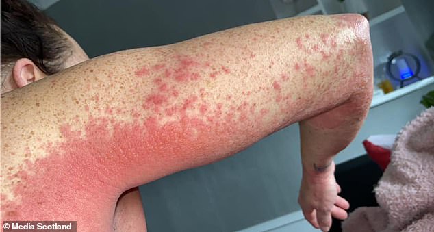 Woman Suffers Unbearable Burning Red Rash On Body From AstraZeneca
